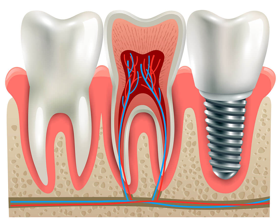 Implant dentar vs. Proteza