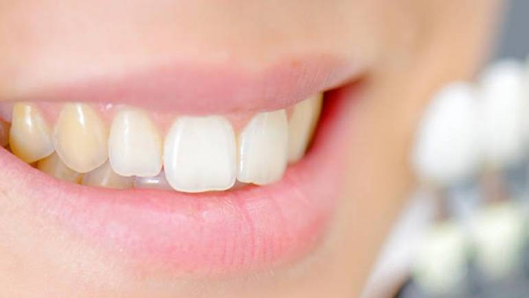 Ce pătează dinții și ce soluții există?